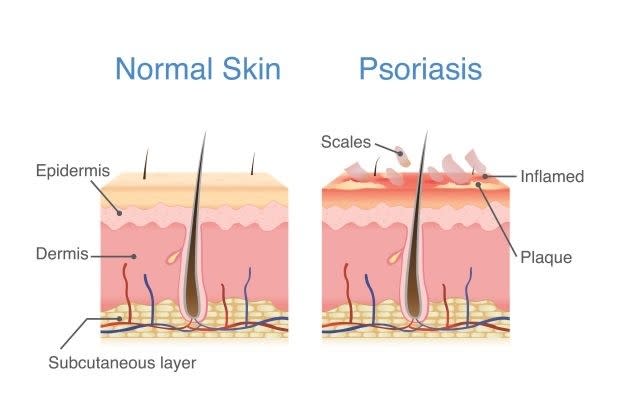 a diagram of a healthy skin vs. psoriasis