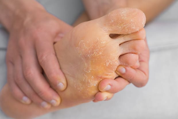 a foot with a fungal infection