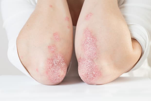 psoriasis patches on the elbows