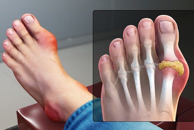 an image displaying the inflammation of gout in the big toe