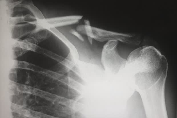 an x-ray of a broken collar bone