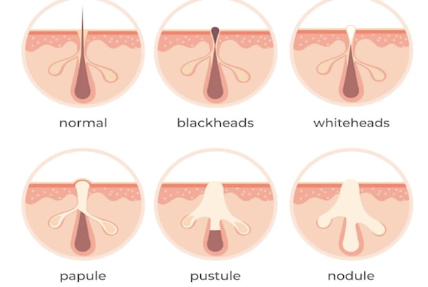 a diagram of different types of acne