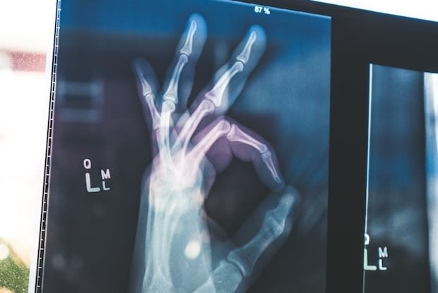 an x-ray of a hand doing the OK sign