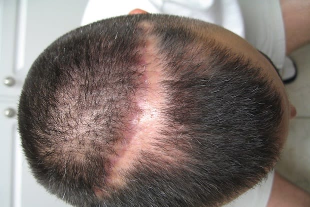 image of scarred scalp