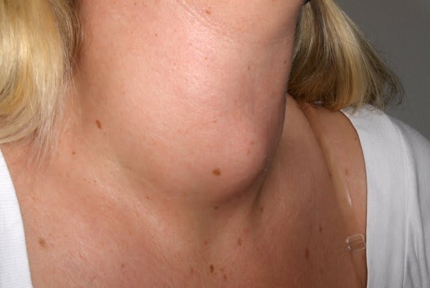  a woman with a goiter in her neck