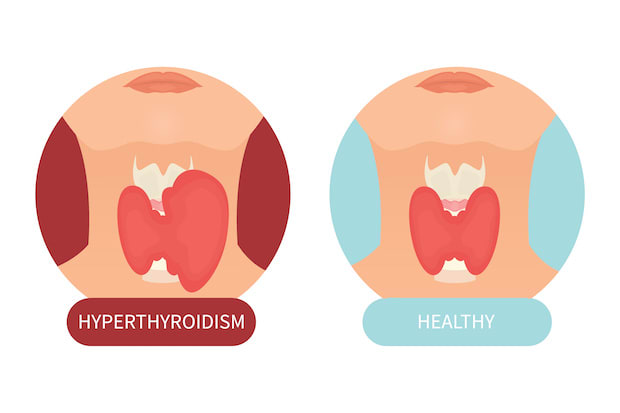 a diagram showing a thyroid with hyperthyroidism versus a healthy thyroid