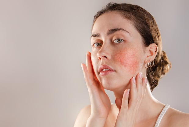 a woman with rosacea