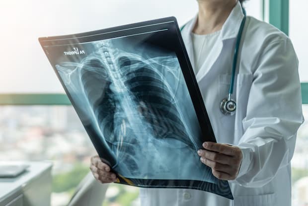 a doctor looking at an x ray of the lungs