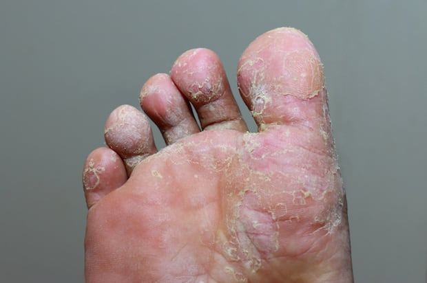 a foot with peeling skin from athlete’s foot