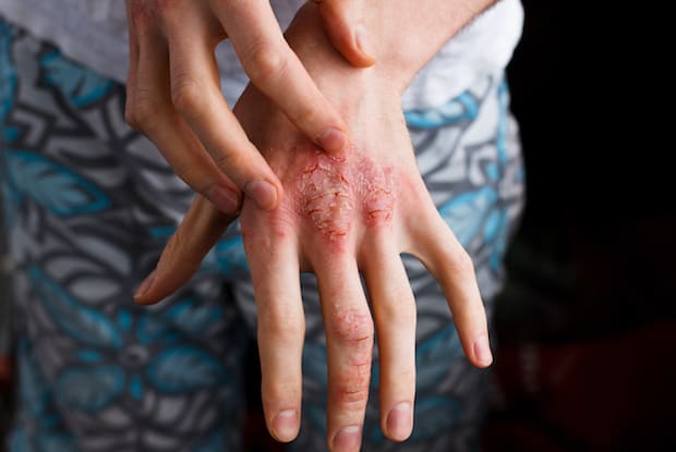 a hand with psoriasis scales