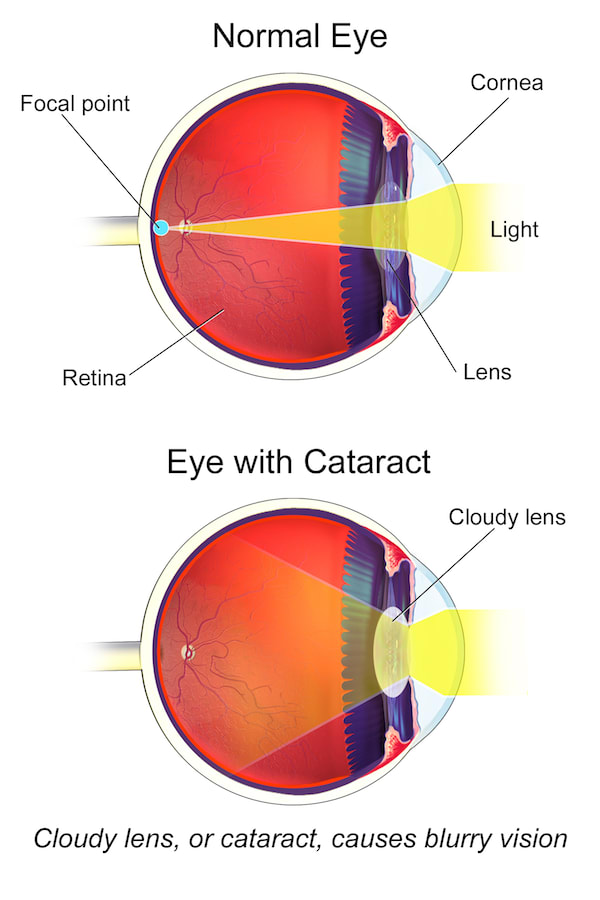 A diagram showing how cataracts can caused blurred vision