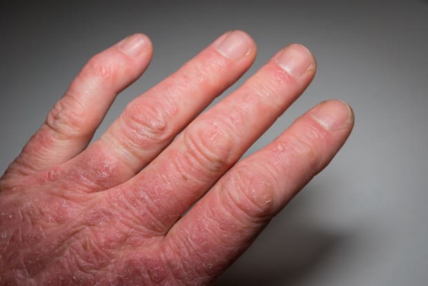 a hand with swollen knuckles