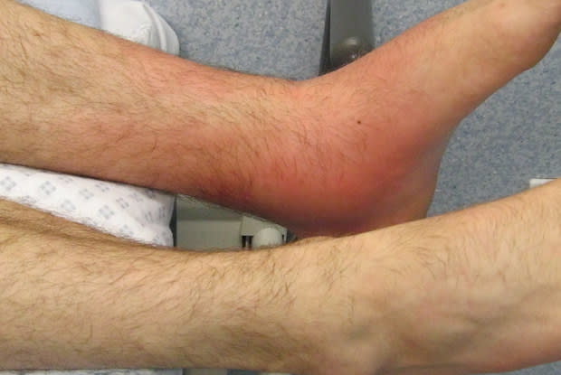 an inflamed ankle