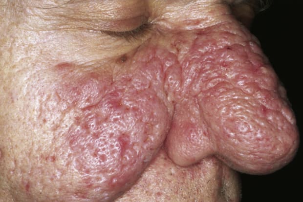 A man showing rosacea redness and bulbous nose