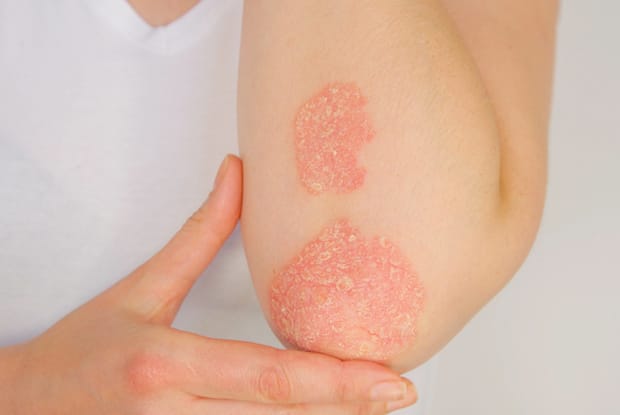 psoriatic arthritis patches on elbows