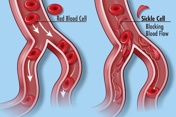 An illustration showing the difference between healthy and mutated red blood cells