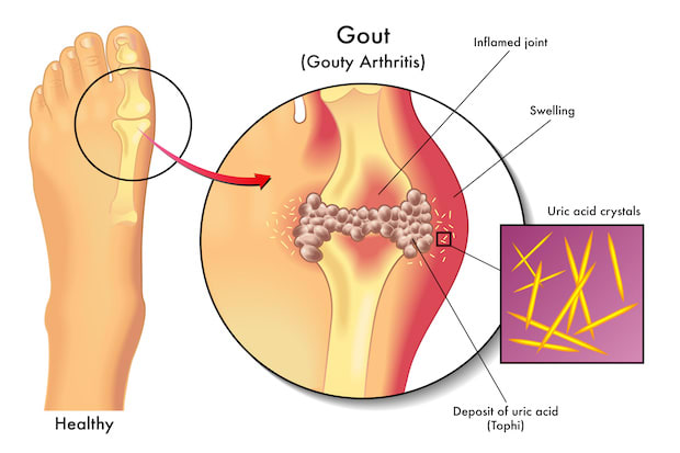 a diagram displaying how uric acid forms in joints