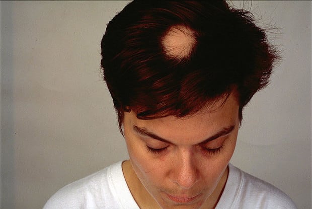 female with small bald spot on scalp