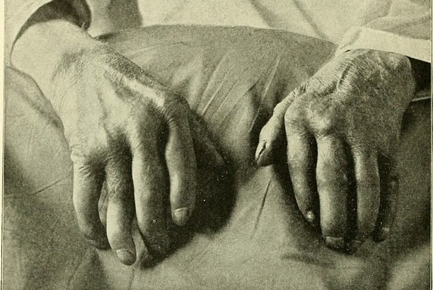 a person’s hands affected by gout and deformed joints