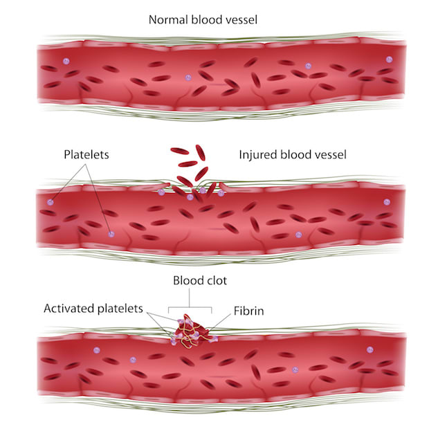 a diagram showing how a blood clot forms in a blood vessel