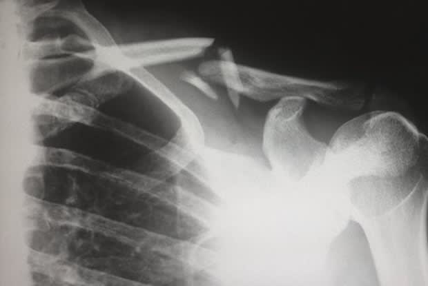 An x-ray of a fractured shoulder