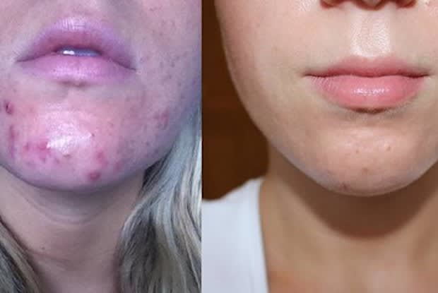 a woman before and after with acne on her chin