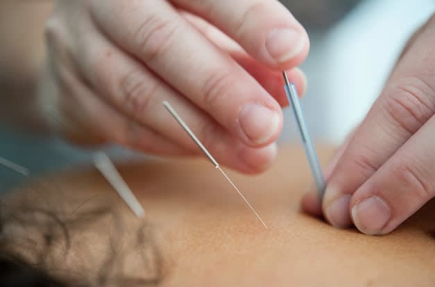 acupuncture needles