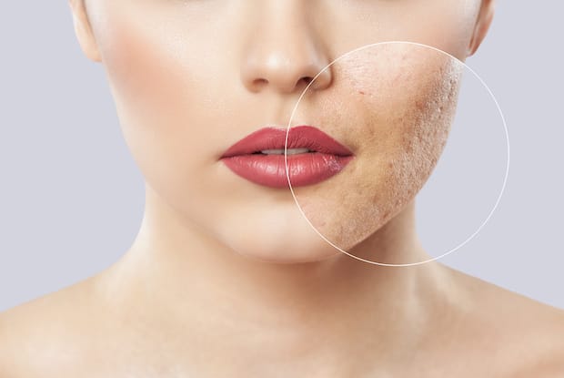 a woman with acne