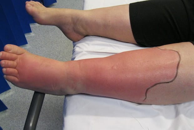 A leg with cellulitis