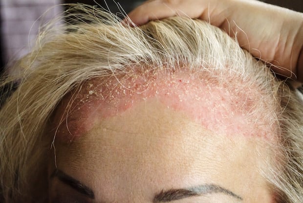 a woman with scalp psoriasis