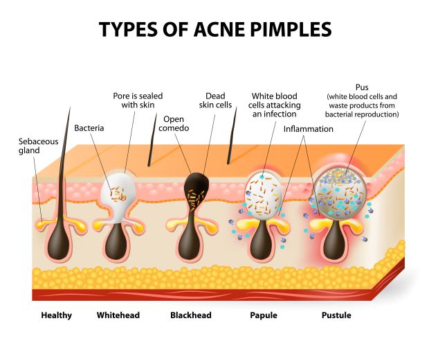 a chart detailing the different types of acne