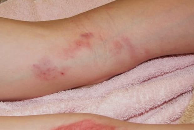 Eczema rashes on the back of legs