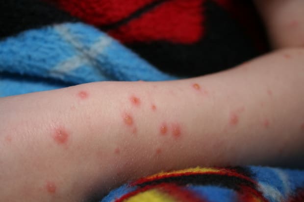 A leg covered with chickenpox blisters