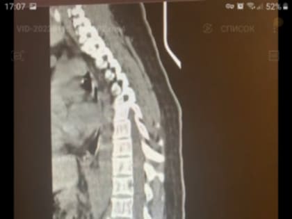 Клинический случай. Травма после катания на тюбинге.