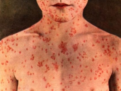 А ты привит от кори?