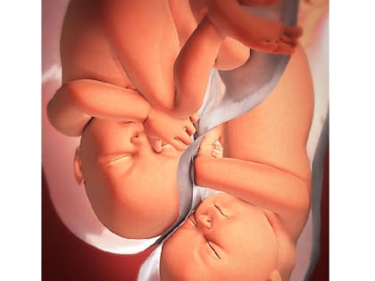 Успешное лечение бесплодия, а затем сохранение многоплодной беременности врачами КГБУЗ «КМКБ № 4».