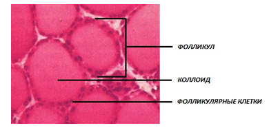 Фолликулярная железа. Микрофолликулярная аденома щитовидной железы. Макрофолликулярная аденома щитовидной железы. Коллоидная макрофолликулярная аденома. Фолликулярная гиперплазия щитовидной железы.