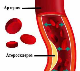 Атеросклероз синдром лериша. Облитерирующий атеросклероз сосудов ног. Холестериновые бляшки в сосудах. Атеросклероза (облитерирующего) артерий ног. Атеросклероз артерий н к.