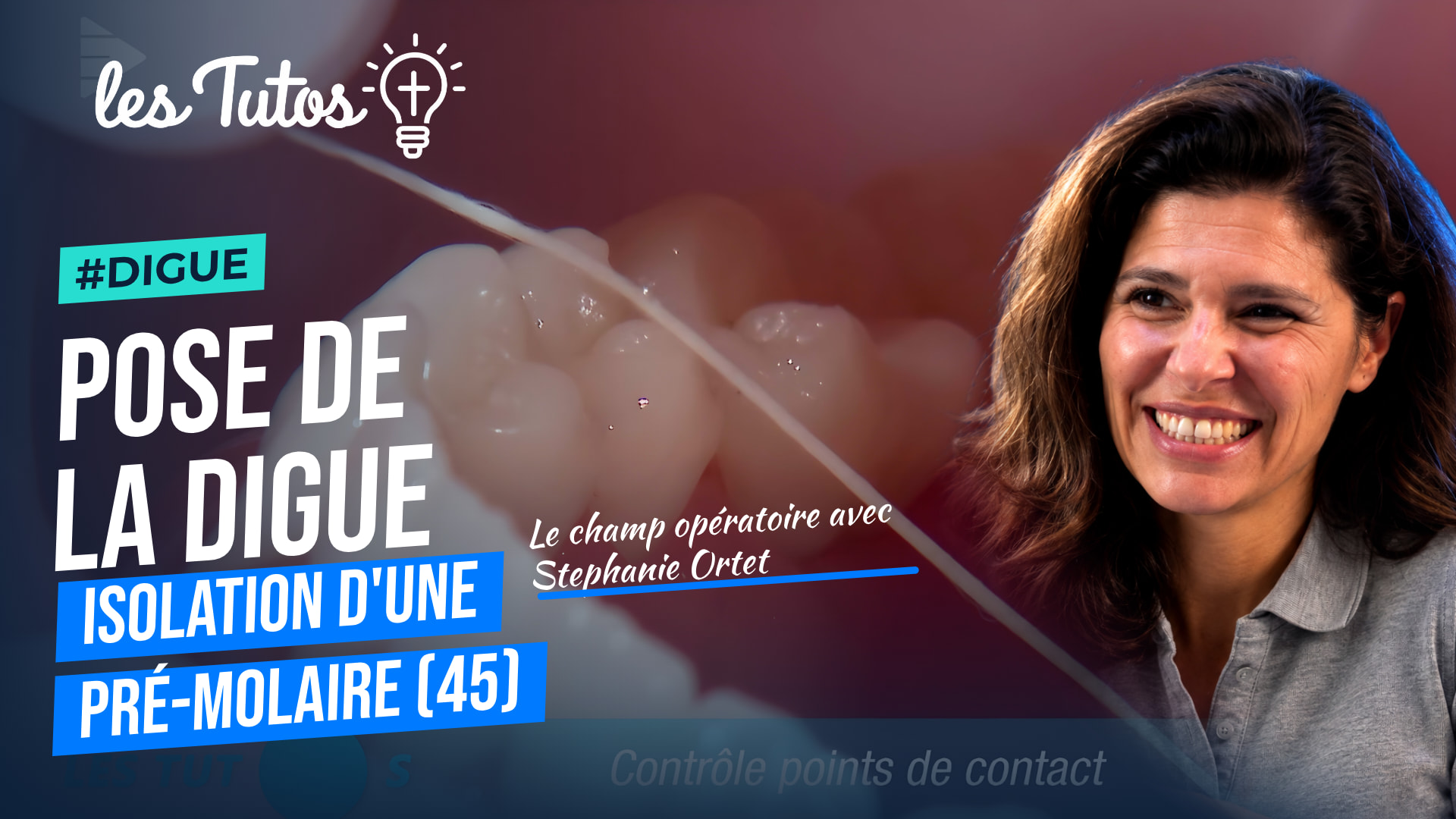 Pose de la digue isolation d'une pré-molaire (45) (Tuto, saison 1 épisode 24) : Isolation d'une pré-molaire à l'aide d'un champ opératoire