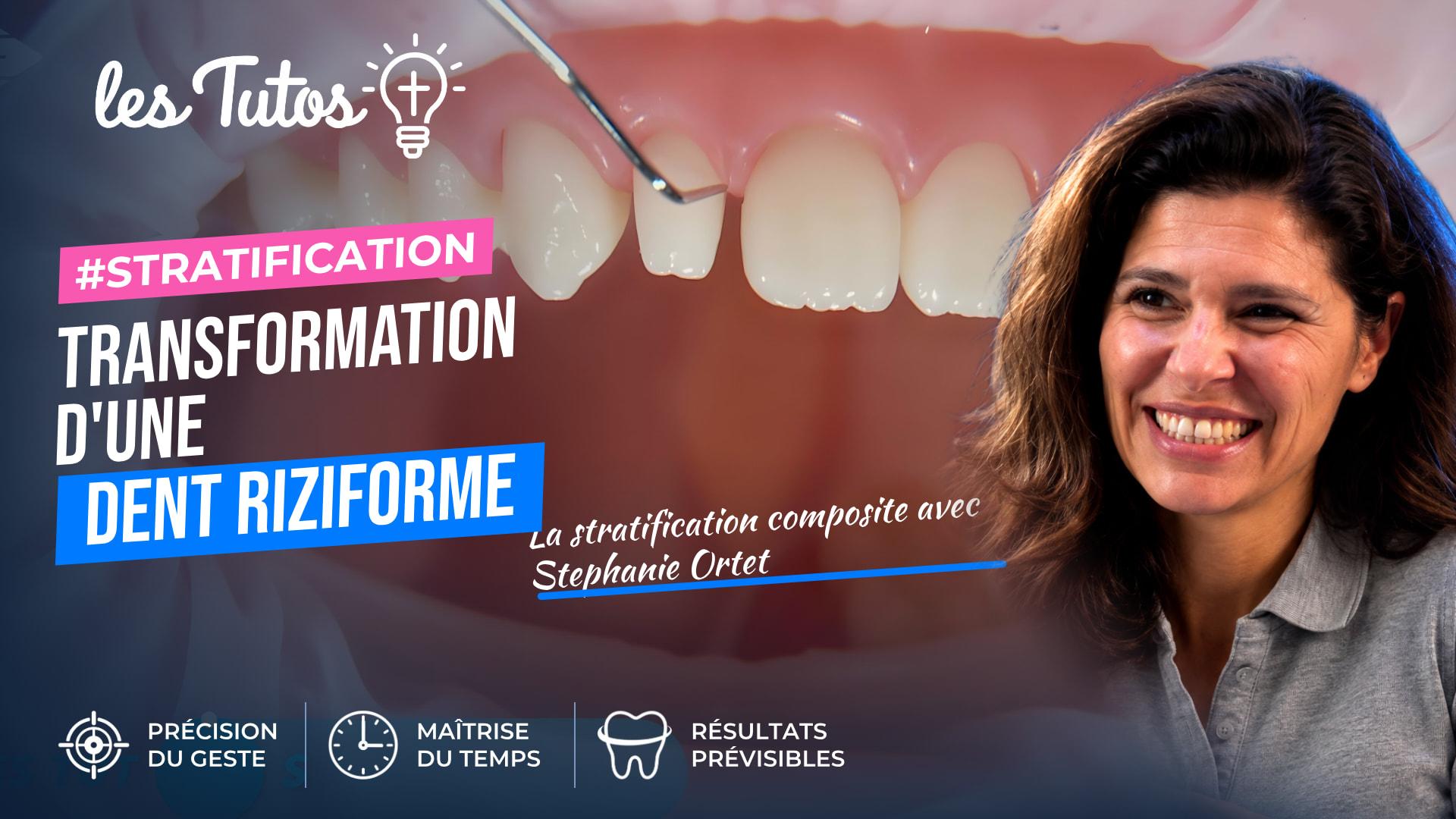 Transformation d'une dent riziforme (Tuto, saison 1 épisode 25) : Transformation d'une latérale riziforme par stratification en composite