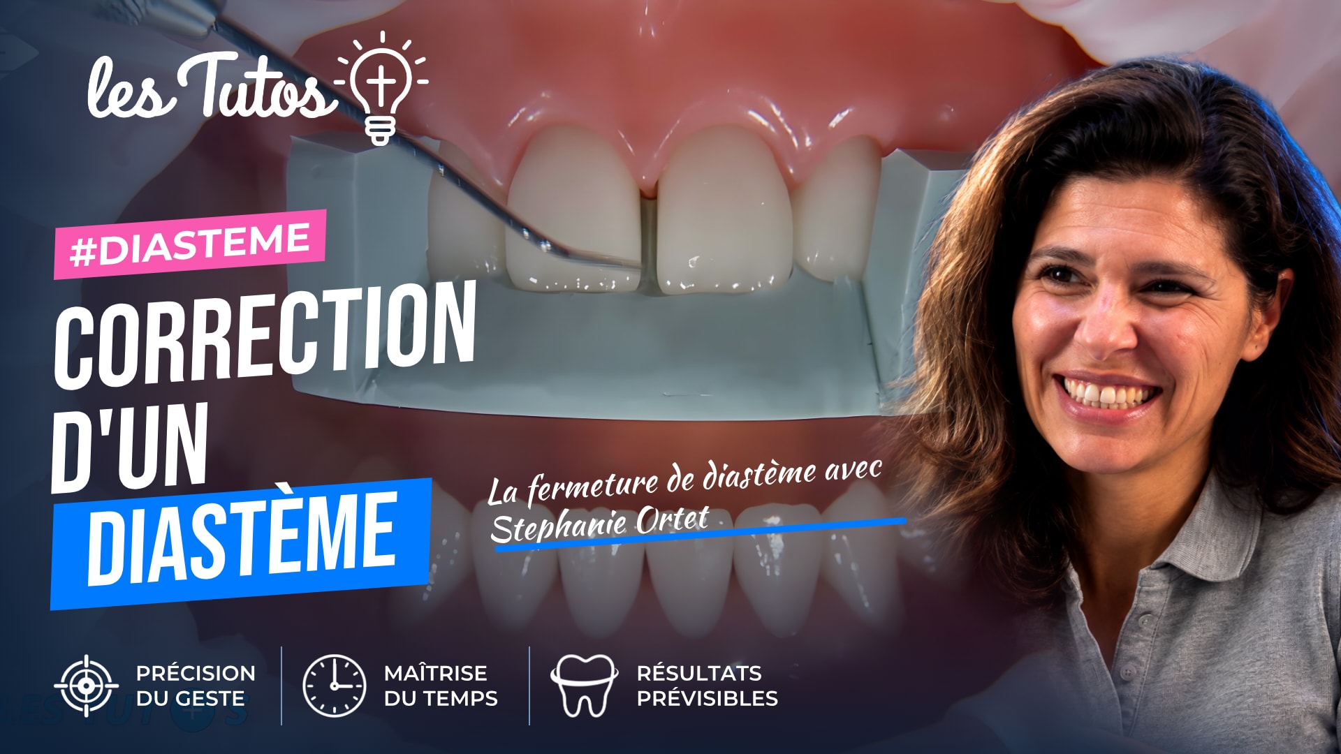 Correction d'un diastème (Tuto, saison 1 épisode 26) : Le Dr Stéphanie Ortet démontre dans ce tutoriel les étapes précises pour la correction d'un…