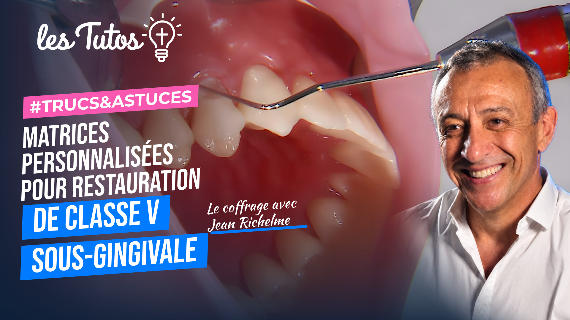 Matrices personnalisées pour restauration de classe v sous-gingivale (Tuto, saison 1 épisode 2) : Mise en place d'une matrice personnalisée pour un…