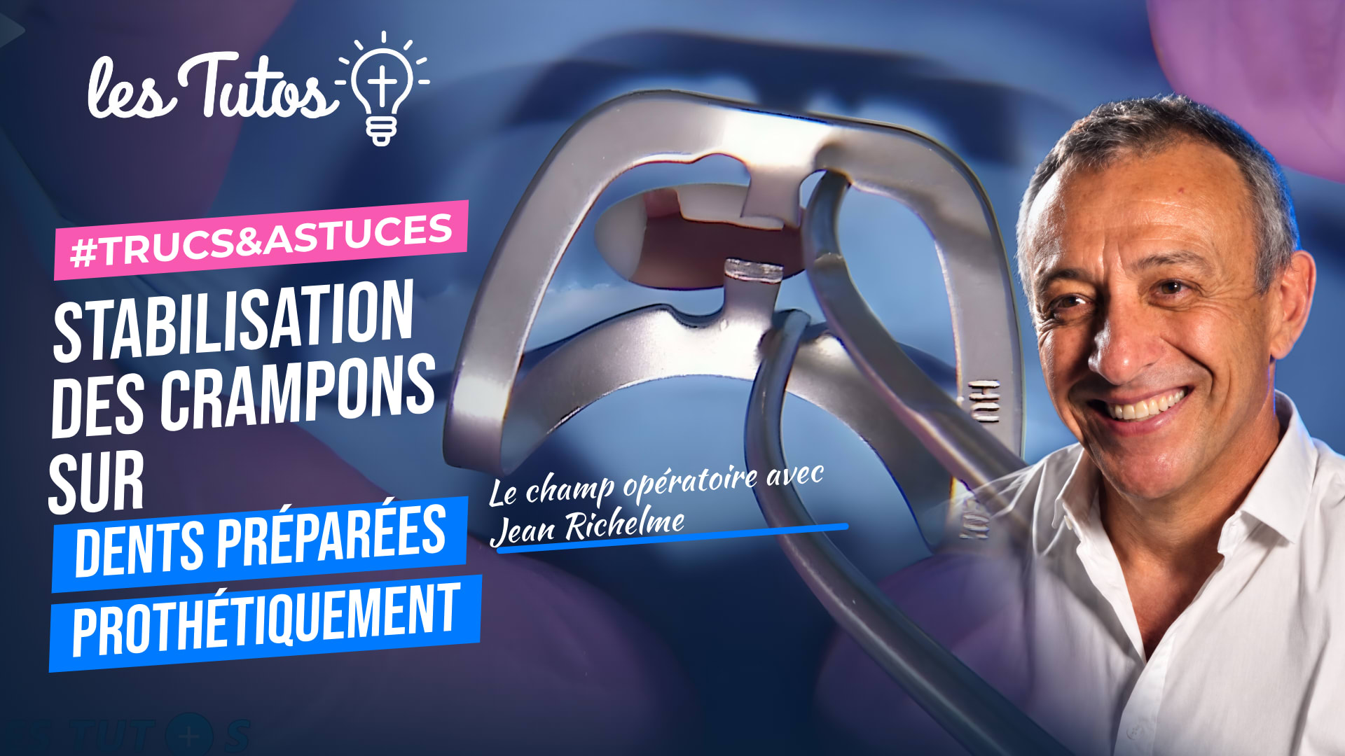 Stabilisation des crampons sur dents préparées prothétiquement (Tuto, saison 1 épisode 3) : Maintien des crampons dans des situations cliniques…