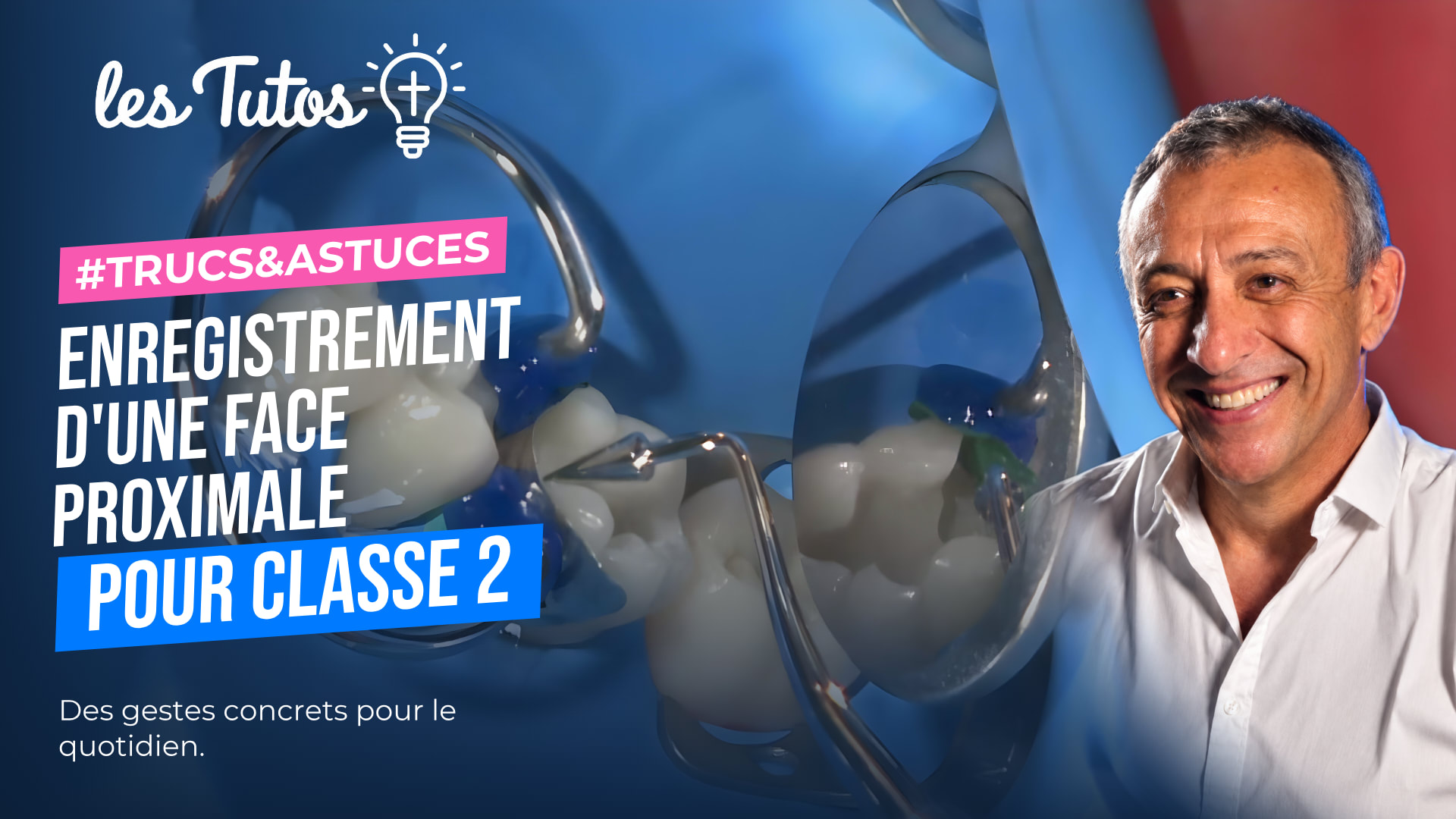 Enregistrement d'une face proximale pour classe 2 (Tuto, saison 1 épisode 4) : Enregistrement d'une crête marginale afin d'en faciliter la…
