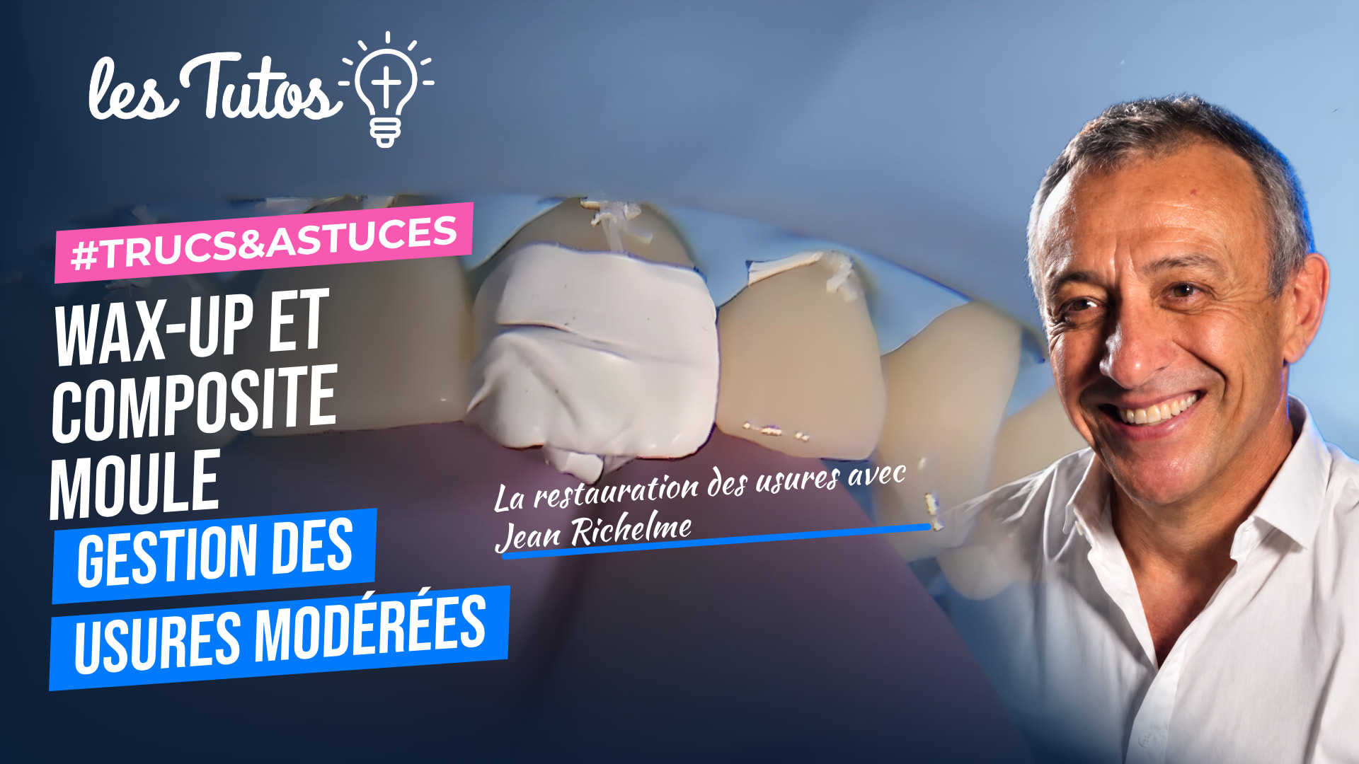 Wax-up et composite moule gestion des usures modérées (Tuto, saison 1 épisode 6) : Restauration de bords libres usés à l'aide de composite moulé