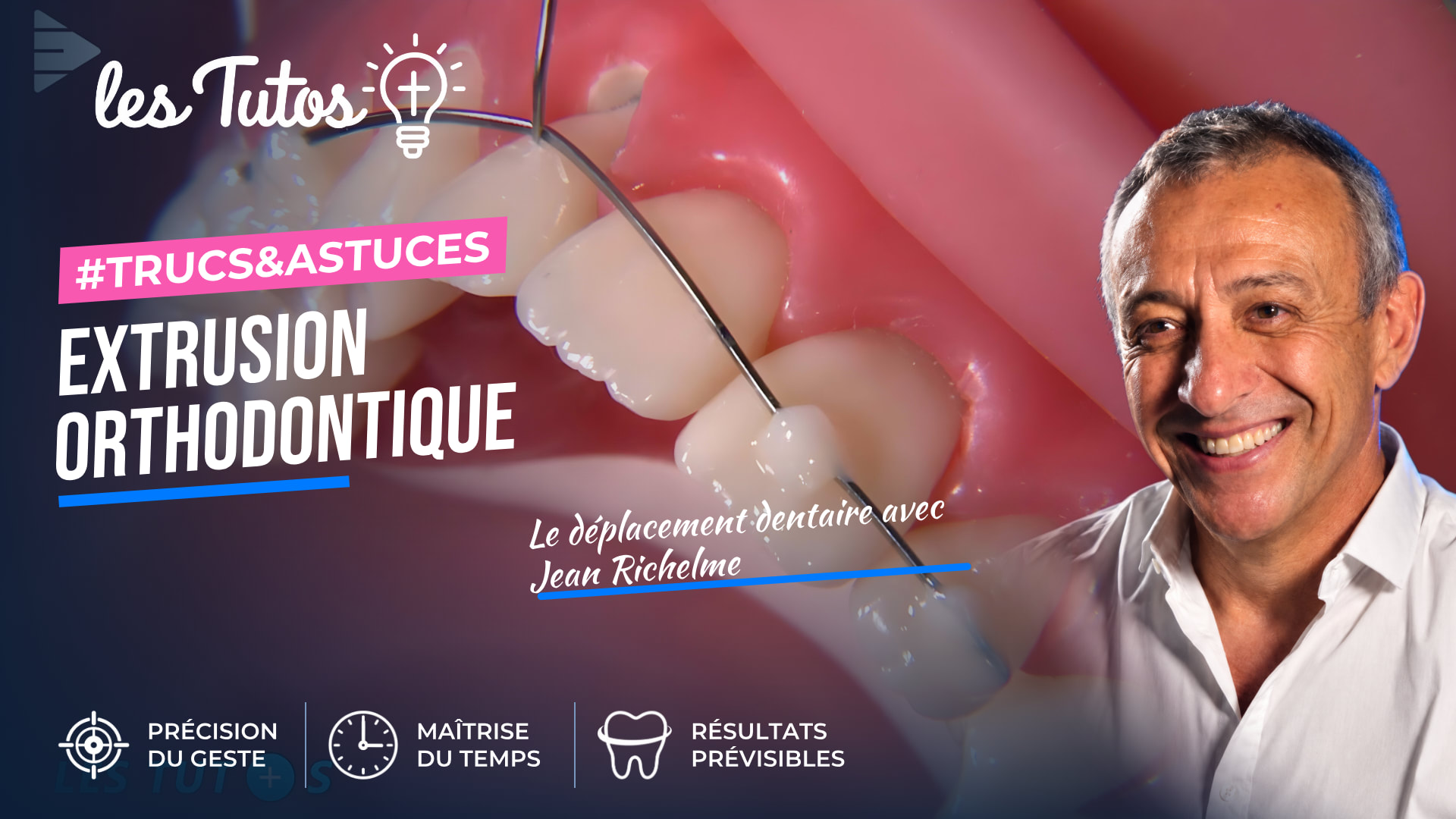Extrusion orthodontique (Tuto, saison 1 épisode 8) : Utilisation de fil d'orthodontie pour permettre l'extrusion d'une incisive latérale