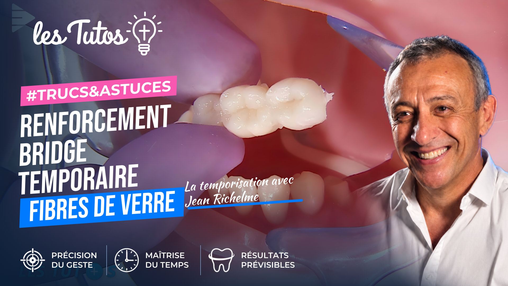Renforcement bridge temporaire fibres de verre (Tuto, saison 1 épisode 9) : Renforcement d'un bridge provisoire avec fibre de verre dans le secteur…