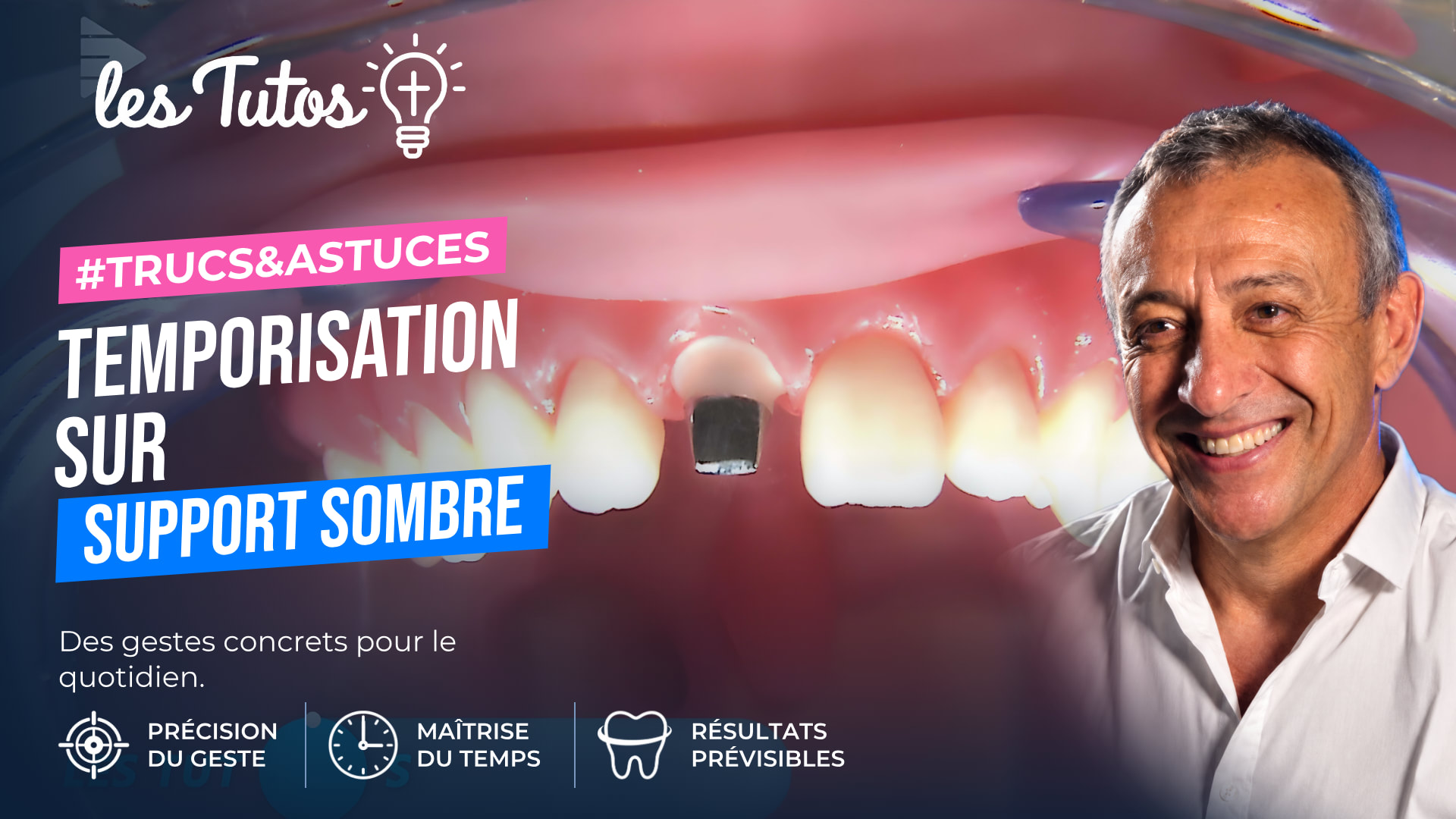 Temporisation sur support sombre (Tuto, saison 1 épisode 12) : Réalisation de provisoire en résine composite sur support métallique