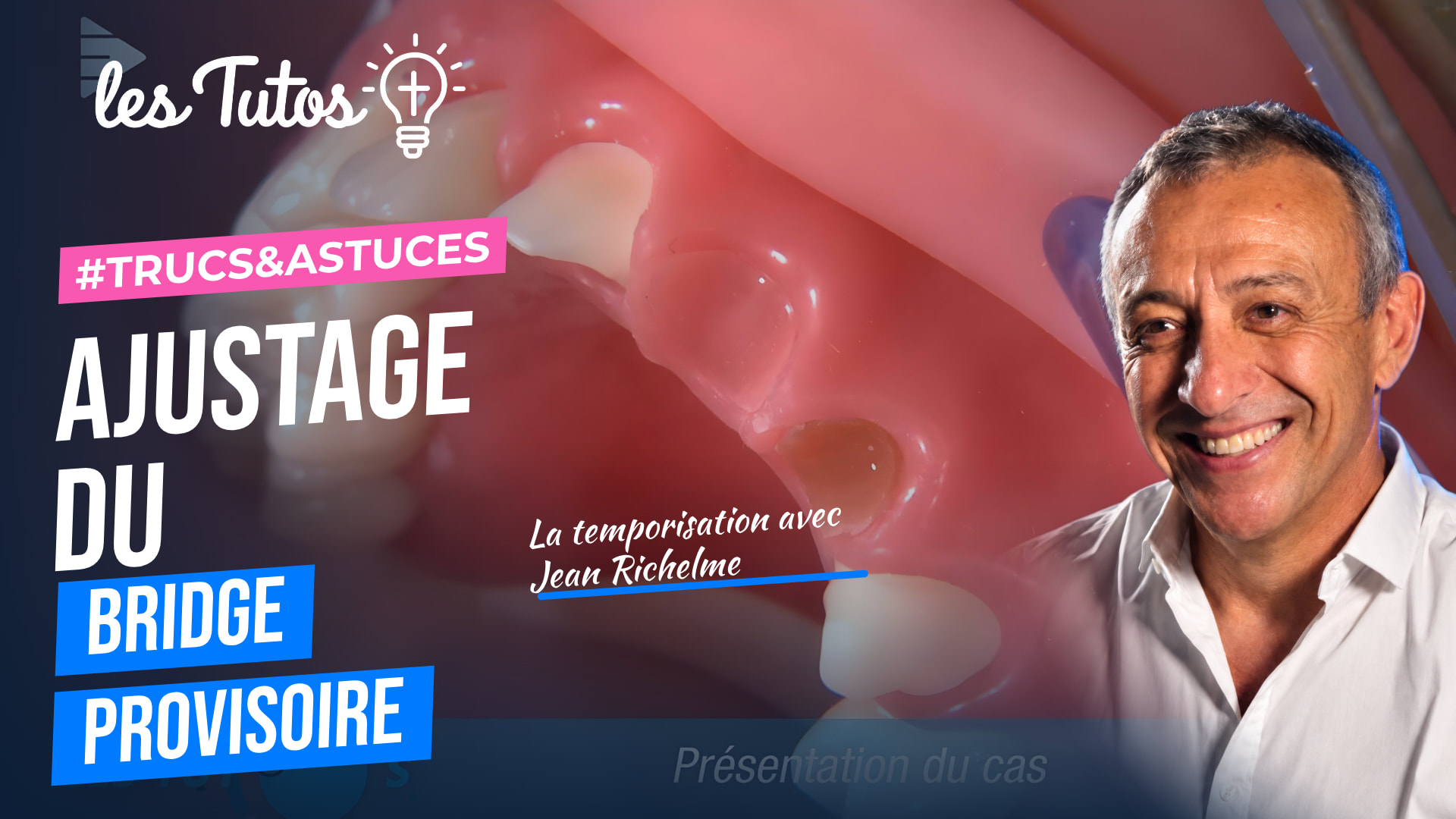 Ajustage du bridge provisoire (Tuto, saison 1 épisode 13) : Le Dr Jean Richelme explique l'ajustage précis d'un bridge provisoire dans cette vidéo…
