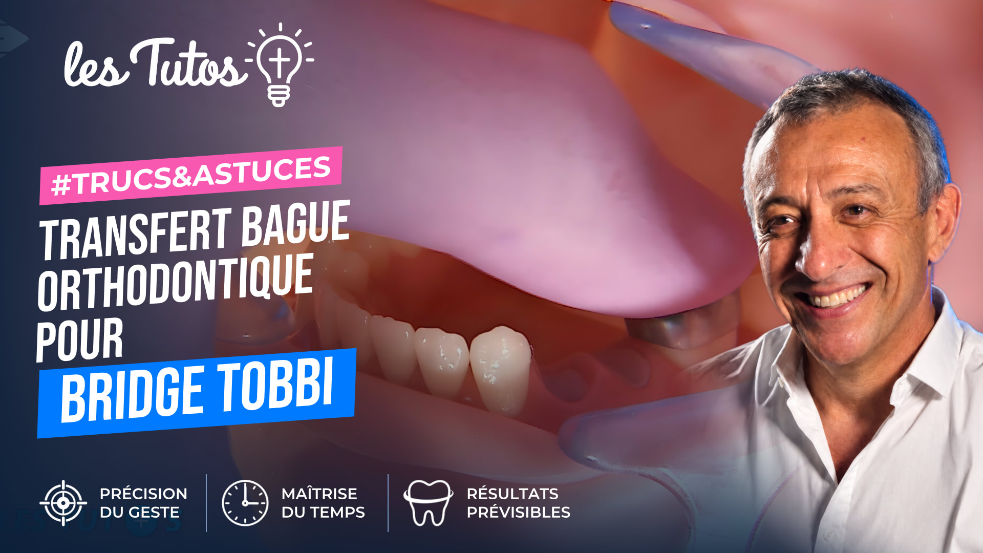 Transfert bague orthodontique pour bridge tobbi (Tuto, saison 1 épisode 15) : Transfert de bague orthodontique pour bridge TOBBI